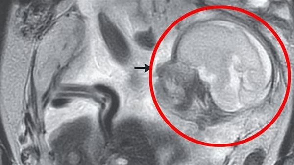 الحمل خارج الرحم