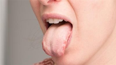 احذر قد تكون مصابا بالسرطان.. متى يكون لون اللسان خطيرًا؟