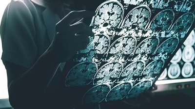 دليل التغلب على المرض.. سيدة تمتلك جين واحد من بين 7 مليارات أخرى يجعلها محصنة ضد الزهايمر