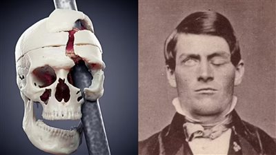 بعد وفاته بـ 162 عاما.. الطب الشرعي يعيد بناء جمجمة رجل أمريكي اخترقت وجهه قطعة حديدية