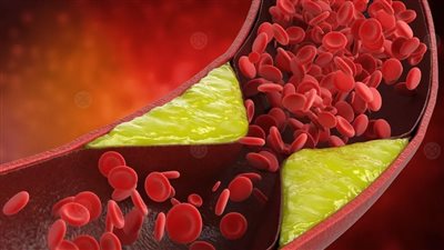 أطباء يحذرون من مخاطر إهمال الكوليسترول.. تعرف على التفاصيل 
