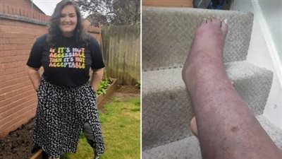  مرض الانتحار│ إصابة سيدة بحالة مرضية مؤلمة.. والأطباء يضطرون إلى بتر قدمها 