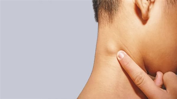  سرطان الغدد الليمفاوية