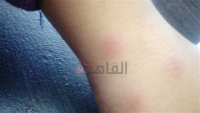 البق بياكل في أجسام ولادنا.. أولياء أمور يستغيثون بسبب انتشار الحشرات بمدرسة لغات في القاهرة