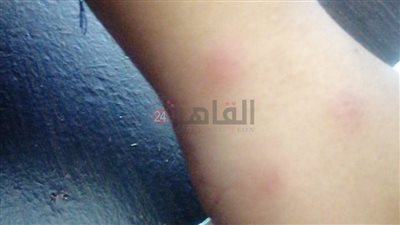 أول تعليق من التعليم بشأن انتشار حشرة البق في مدرسة بالقاهرة