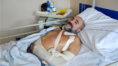 لأول مرة.. إيطالي يخضع لعملية استعادة لـ يده مرة أخرى بعد نقل العصب من ساقه المبتورة