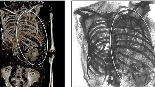 رأس طفل بالحوض وآخر