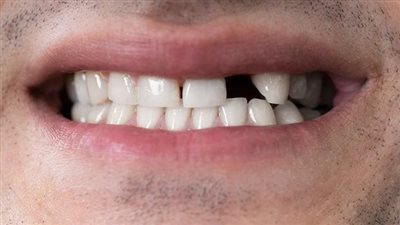 تفسير حلم سقوط الأسنان لابن سيرين.. متى يعبر عن موت أقارب؟