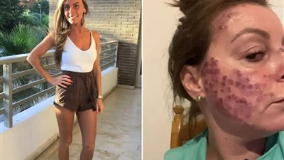 هوس التان.. سيدة تصاب بالسرطان لكثرة استلقائها تحت أشعة الشمس