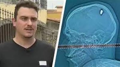 شاب برازيلي يكتشف إصابته بطلق ناري في رأسه بعد 4 أيام