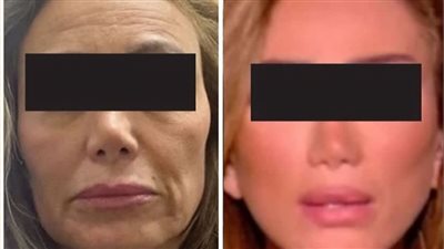 هرفع دعوى عليها.. صور ريهام سعيد بعد عملية التجميل