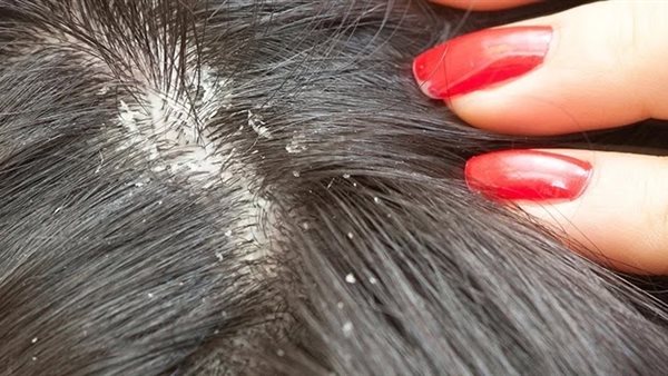 القمل في الشعر في