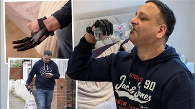 يد ثلاثية الأبعاد.. تركيب طرف صناعي لشخص بريطاني بعد تعرضه لحادث