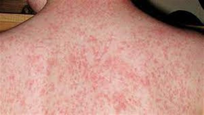 ارتفاع إصابات الحصبة في أمريكا إلى 294 حالة وسط استمرار تفشي المرض