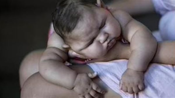 العيوب الخلقية