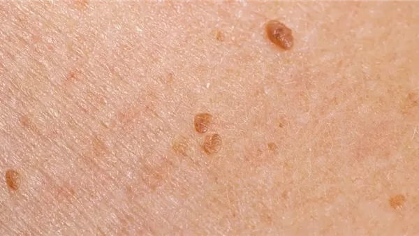 الورم الحليمي