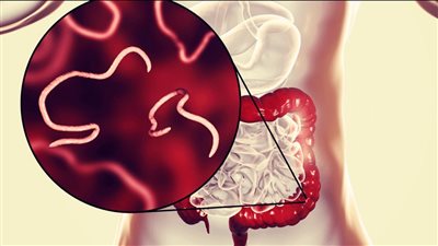 خلال إجازتها في اليابان.. عدوى طفيلية نادرة تصيب امرأة أمريكية بعد تناول وجبة بحرية