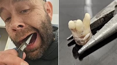 بسبب أزمة الأطباء في بريطانيا.. رجل خمسيني يخلع أسنانه بالزردية