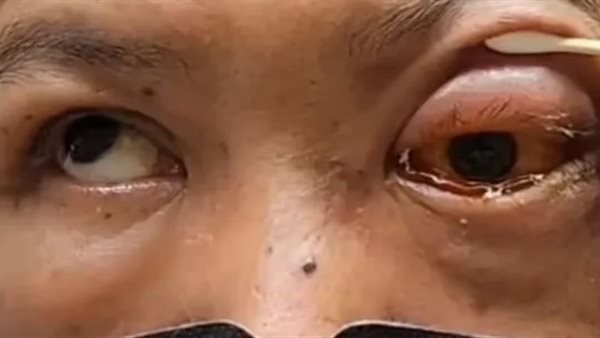 الاعتلال العصبي البصري