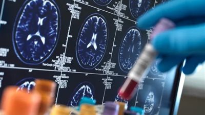 التفاوتات الاجتماعية والاقتصادية ترتبط بخطر الإصابة بالخرف | دراسة 