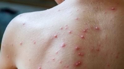 الكونغو تعلن تفشي وباء الجدري