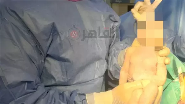 مولودة بعين واحدة