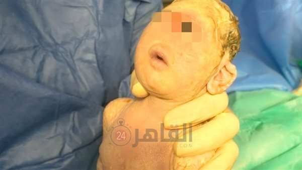 ولادة طفلة بعين واحدة