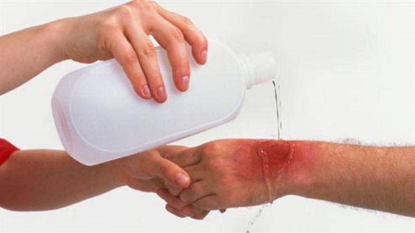 الحروق السطحية 