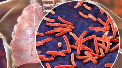 السل والتدخين.. كيف يزيد التبغ من خطر الإصابة بالعدوى؟