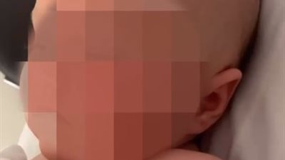 لاحظت انتفاخ رأسها.. أم تكتشف إصابة رضيعتها بمرض نادر في أستراليا