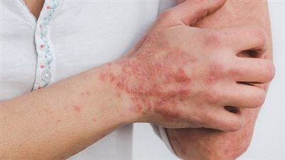 خبراء الصحة البريطانية يحذرون من خطر الإصابة بمرض القوباء المنطقية 