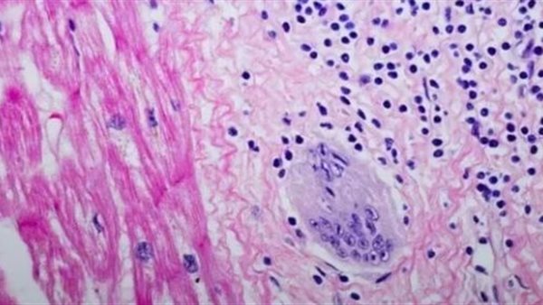 فحص الدم لتشخيص الساركويد