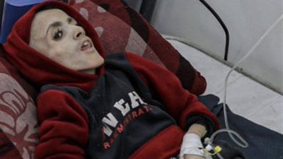 استشهاد الصغير يزن الكفارنة بسبب سوء التغذية في غزة