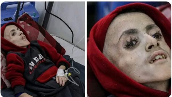 المجاعة في غزة 