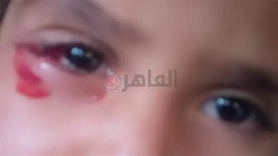 إصابة صغيرة إثر انفجار صاروخ ألعاب نارية في عينها بالفيوم 