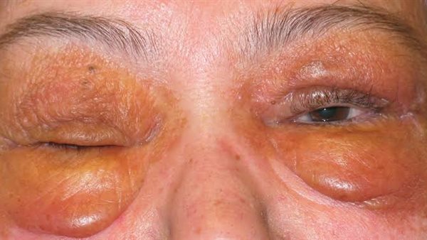 الداء النشواني