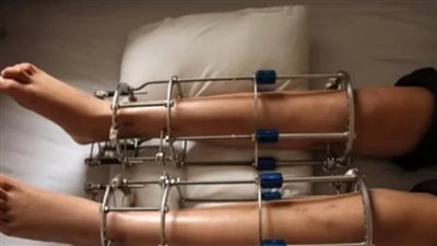 بعد وفاة سعودي في تركيا.. كم تتكلف عمليات تطويل القامة وهل تسبب الوفاة؟