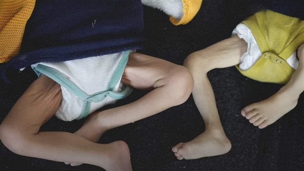 أزمة المجاعة وسوء