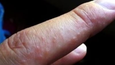 مرض جلدي نادر يصيب الأطفال.. استشاري يوضح طرق الوقاية