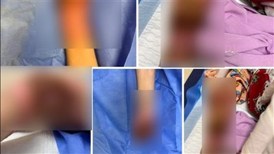 حطوا أيديها ورجليها في مياه مغلية.. ضحى فقدت أطرافها بعد اعتداء أسرتها عليها| صورة 