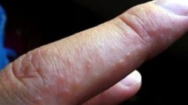 مرض التهاب الجلد