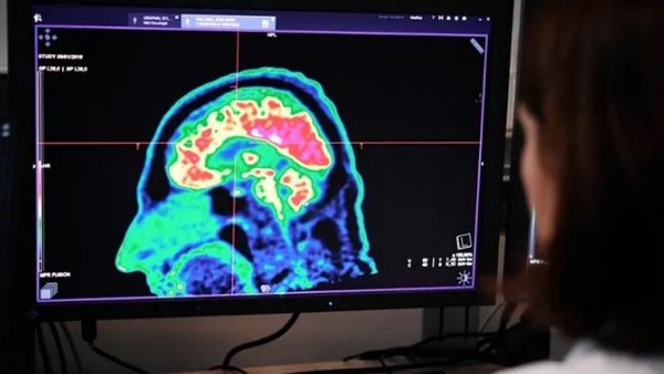 أعراض متلازمة الهافانا