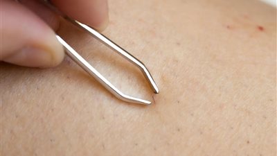 رجل يدخل في غيبوبة بسبب إزالة شعر من جسده بمنطقة الفخذ