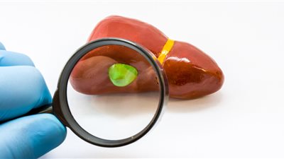 خبراء يؤكدون مدى ترابط الحصوات بإصابة سرطان المرارة