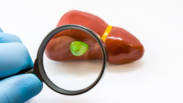 سرطان المرارة 