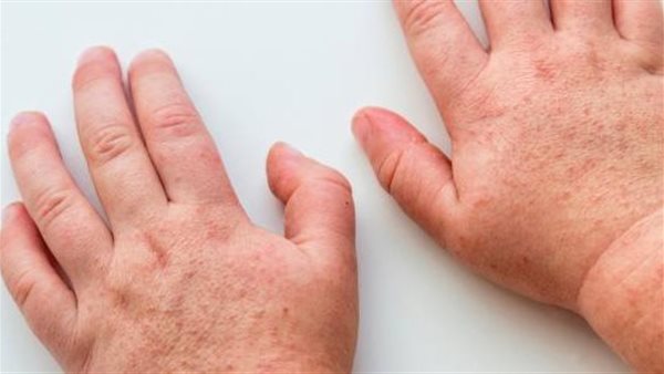 الحمى القرمزية