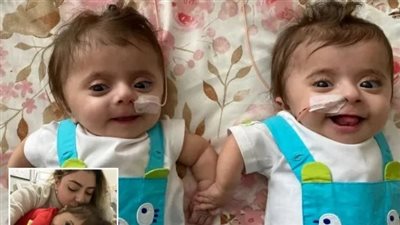 إصابة توأم بمرض وراثي نادر في العظام.. تعرف على الأعراض