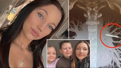 إزالتها تهدد حياتها.. وسيلة منع حمل تستقر في الشرايين الرئوية لسيدة بريطانية