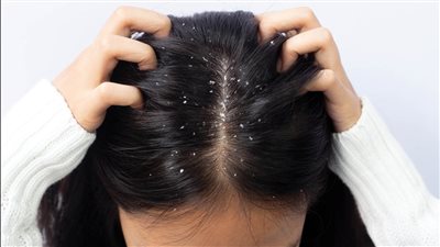 حالات جلدية خطيرة ترتبط بقشرة الشعر.. تعرف عليها