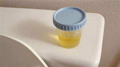 دراسة: اختبار البول الجديد يساعد الناجين من سرطان المثانة